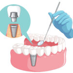 Greffe osseuse pour implant : Guide complet et conseils