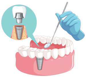 Greffe osseuse pour implant : Guide complet et conseils